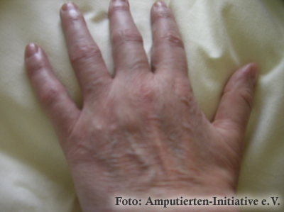 Sudeck an Hand