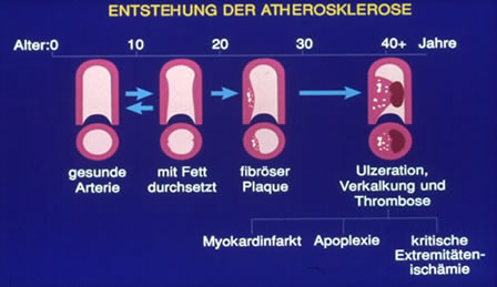 Entstehung der Atherosklerose